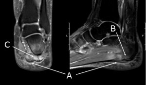 Plantar heel pain syndrome; Thickening of plantar fascia with intrasubstance signal (A), bone marrow oedema (B), intrinsic muscle oedema (C)