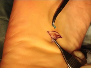 Figure 3. Piece of metal removed from sole of foot