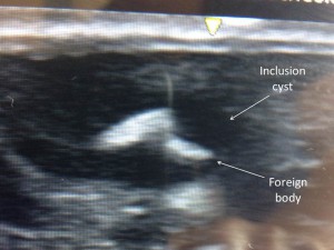 Figure 1. US of inclusion cyst with foreign body
