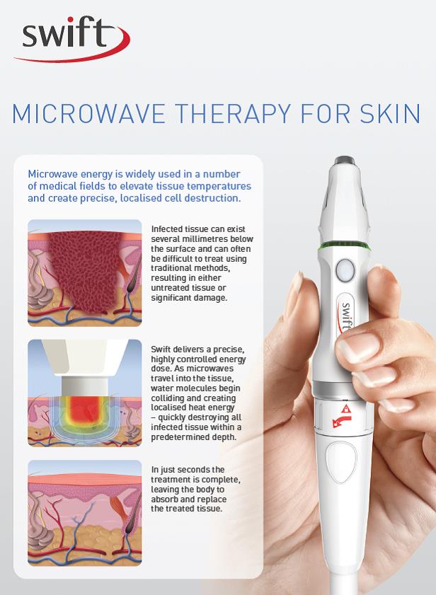 Swift Microwave Verruca Treatment Premier Podiatry